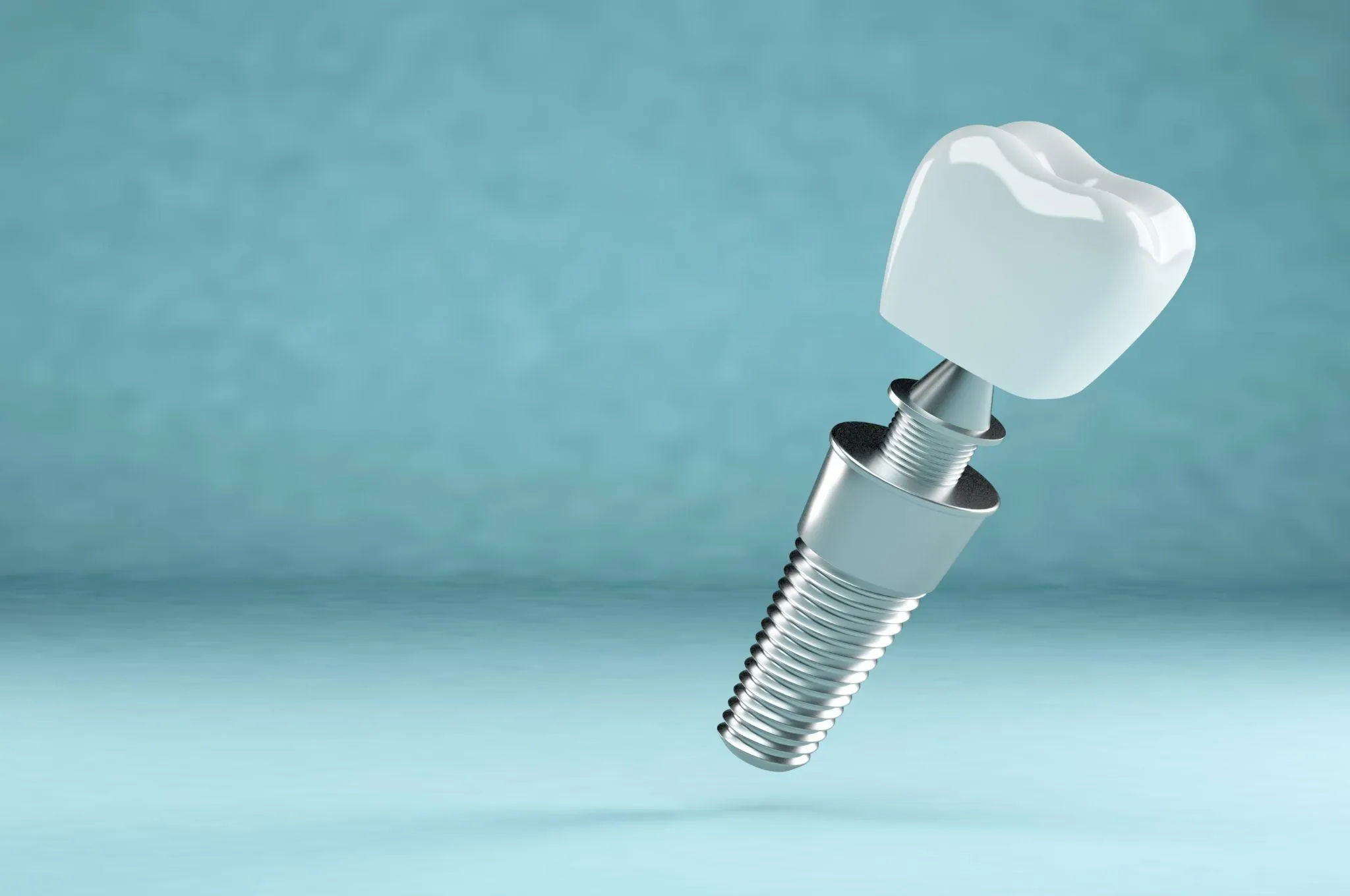 インプラントの寿命を延ばすポイント