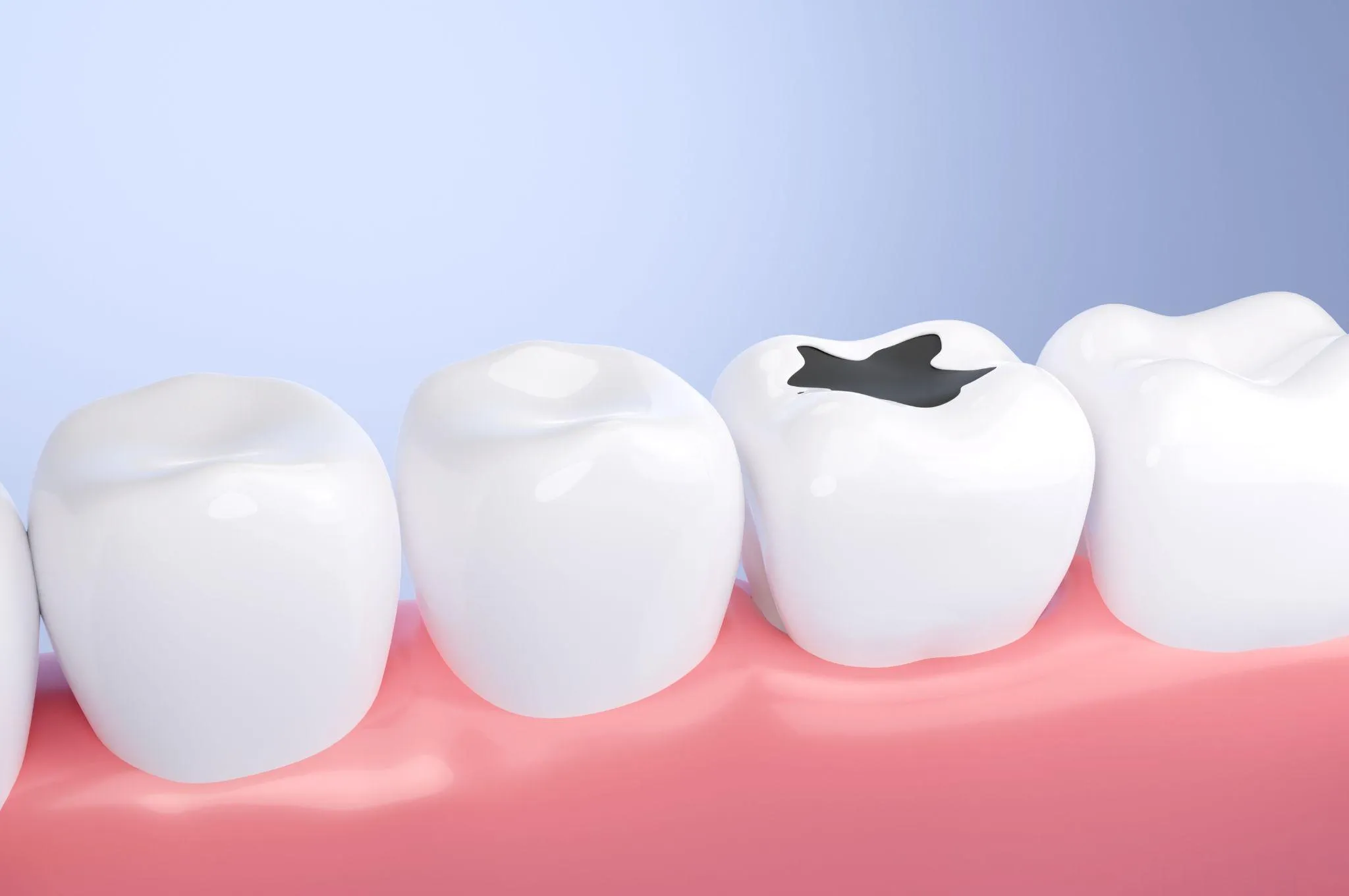 何年放置すると危険？虫歯の進行と時間の関係