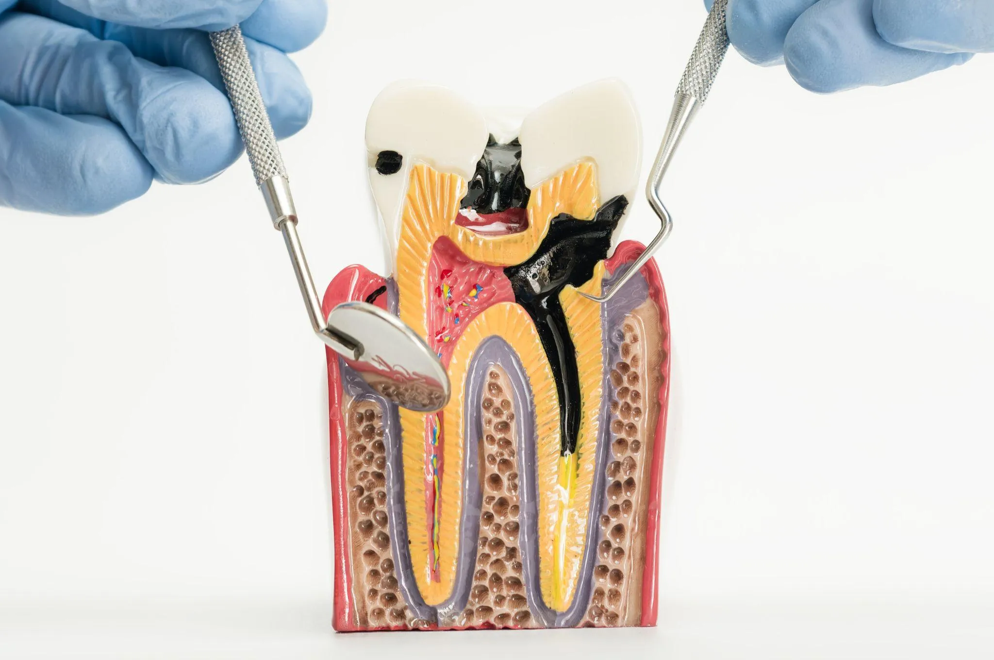 虫歯の進行と各段階の症状