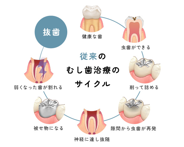 従来のむし歯治療のサイクル